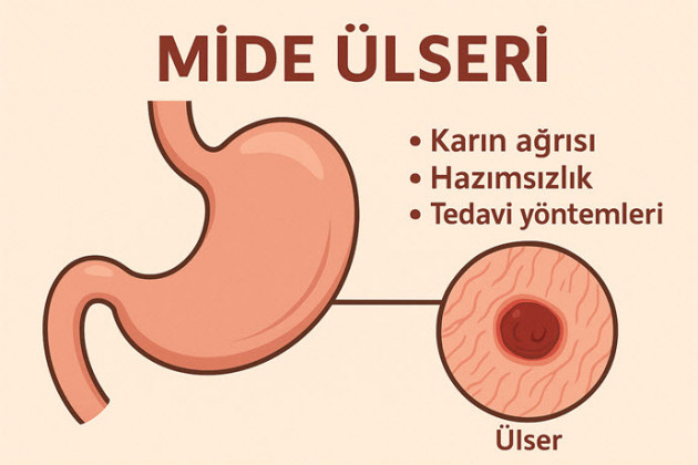 Mide Ülseri Hakkında Bilmeniz Gereken Her Şey