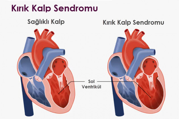 kirik-kalp-sendromu-nedir-3-5836.jpg